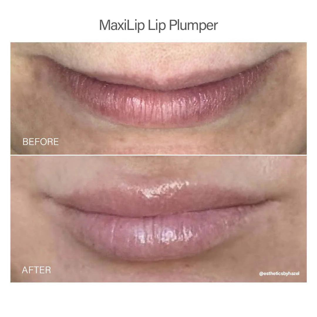 Maxi Lip Plumper - Vivant - Albany Aesthetics