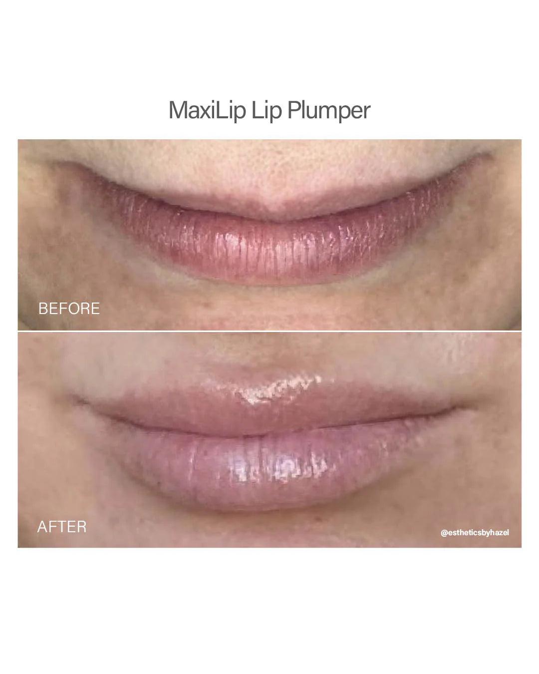 Maxi Lip Plumper - Vivant - Albany Aesthetics