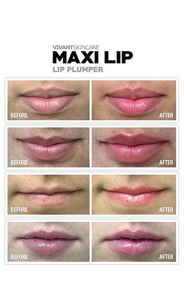 Maxi Lip Plumper - Vivant - Albany Aesthetics