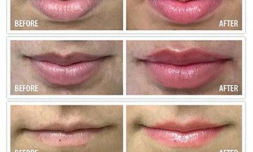 Maxi Lip Plumper - Vivant - Albany Aesthetics